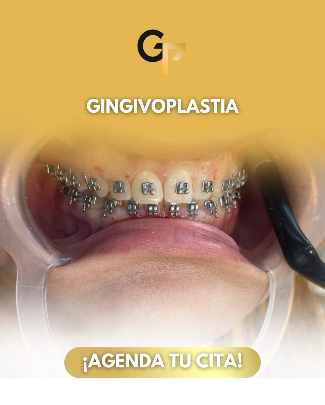 Gingivoplastia: El secreto para una sonrisa más armónica y equilibrada