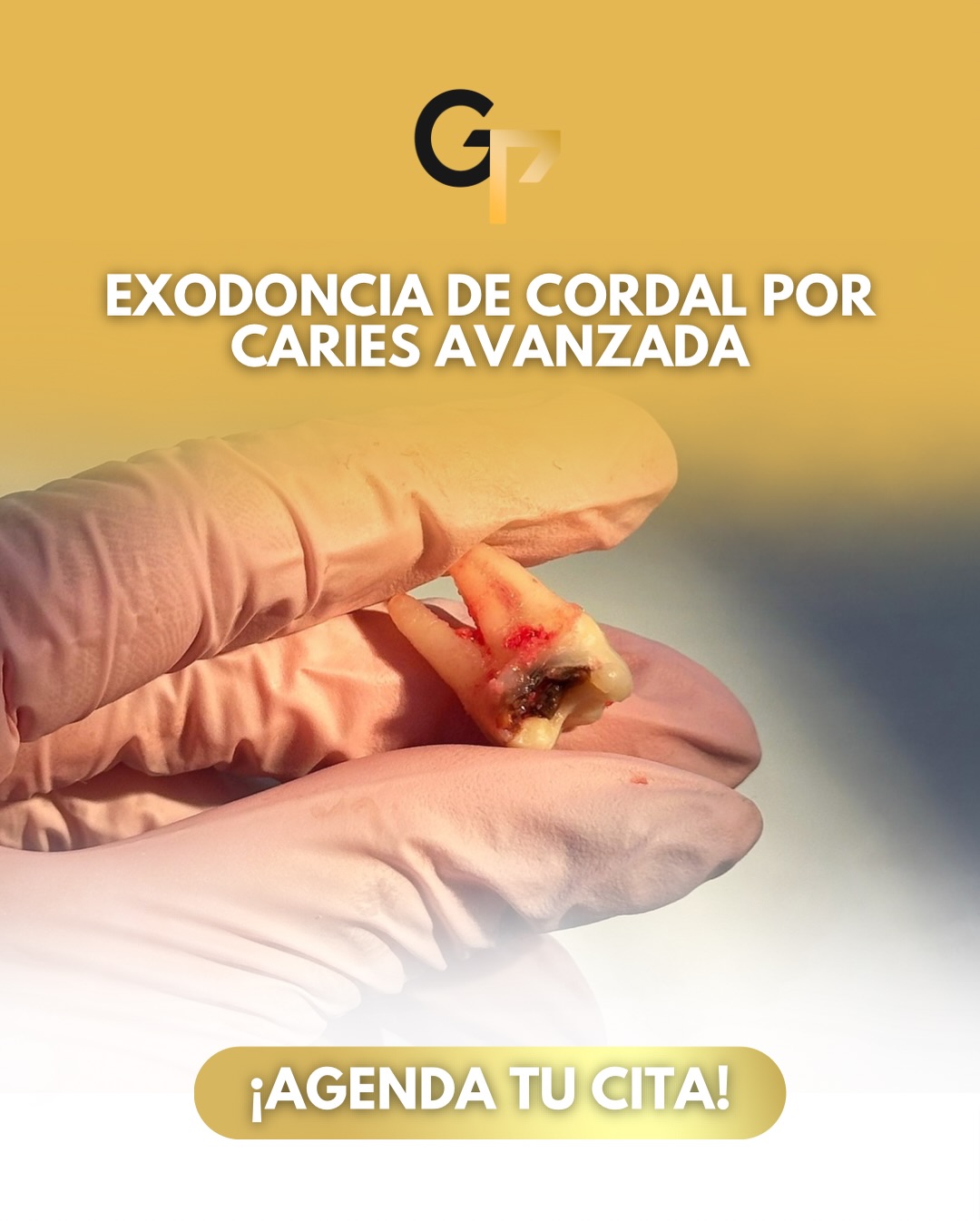 Exodoncia de Cordales por Caries Avanzada: ¿Cuándo es necesario decir adiós?
